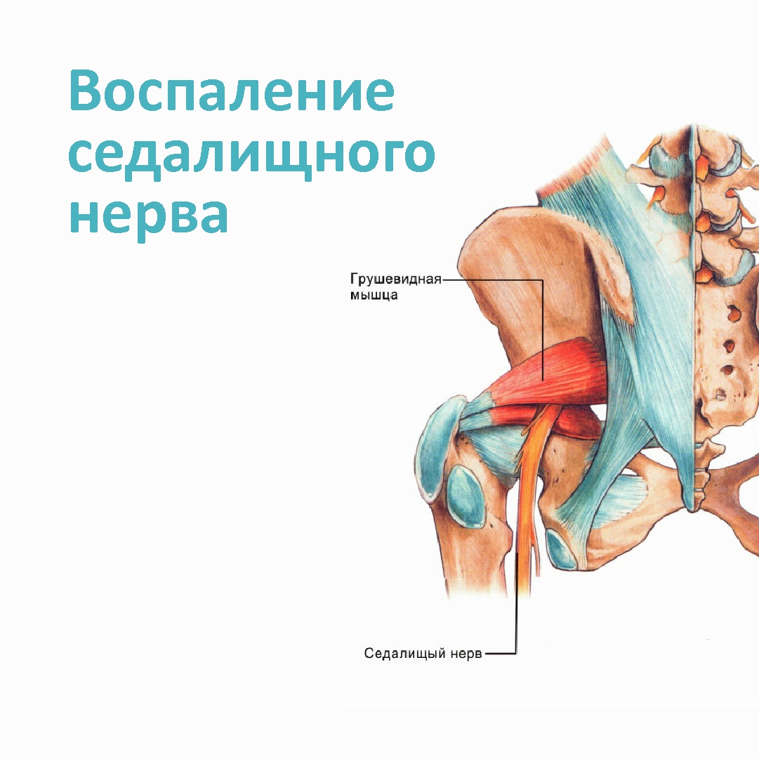 Воспаление седалищного нерва: симптомы лечение | Ремедикум